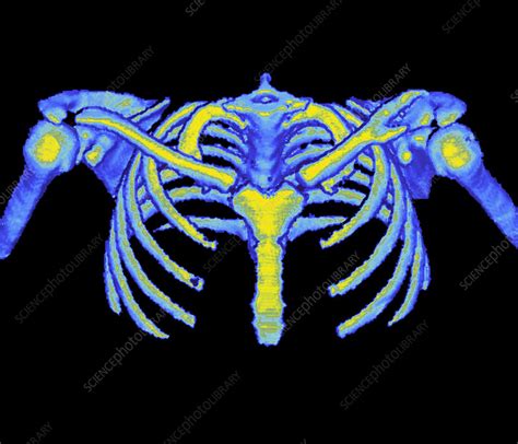 Rib Cage Ct Scan Stock Image P1160458 Science Photo Library