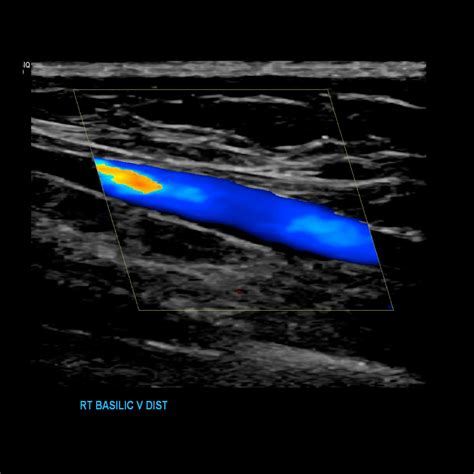 Upper Extremity Venous Doppler Sonographic Tendencies Vascular Ultrasound Vein Thrombosis