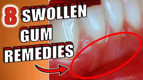 8 Home Remedies To Get Rid Of Swollen Gums Youtube
