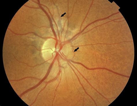Clinical Optical Features Of Pseudoxanthoma Elasticum 141514the Retina