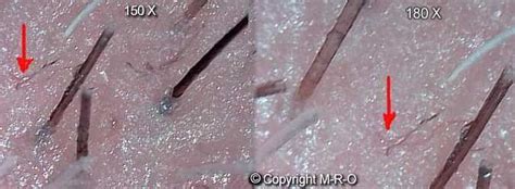 17 Best Images About Morgellons On Pinterest Oil