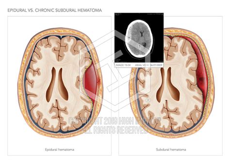 Hematoma is suspected in patients with symptoms and signs of acute, nontraumatic spinal cord compression or sudden, unexplained lower extremity paresis, particularly if a possible cause (eg, trauma, bleeding diathesis) is. Epidural Vs. Chronic Subdural Hematoma | High Impact ...
