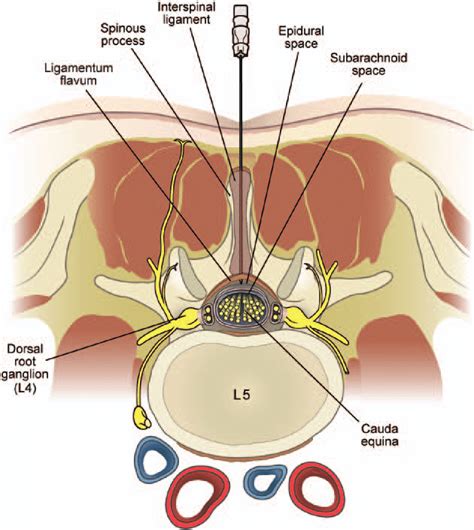 Axial Diagram Of Interlaminar Lumbar Epidural Injection The Epidural