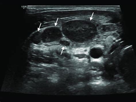 An Ultrasound Of The Patient On Admission Revealed Multiple Lymph Nodes