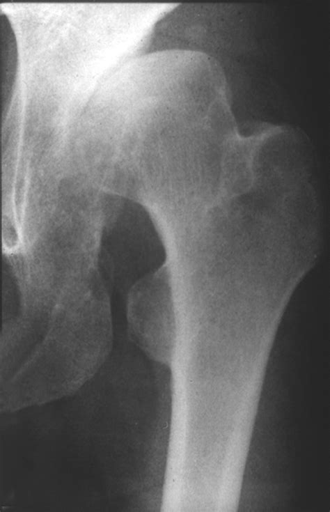 The Chiari Pelvic Osteotomy For Patients With Dysplastic Hips And Poor