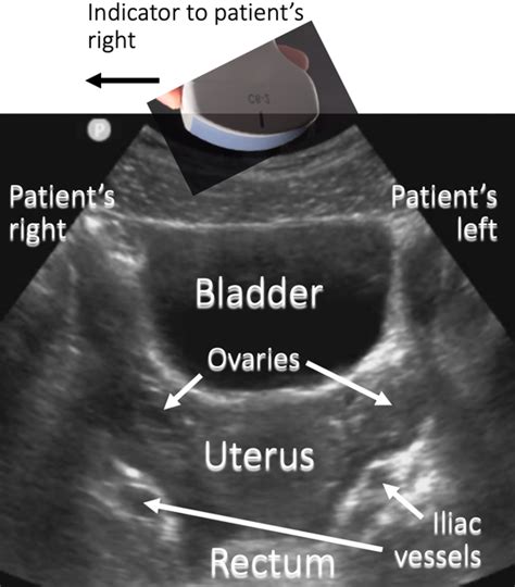 Pelvic Ultrasound Transverse Anatomy
