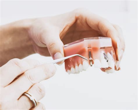Implants dentaires à SeptÎles  Centre dentaire et d'implantologie