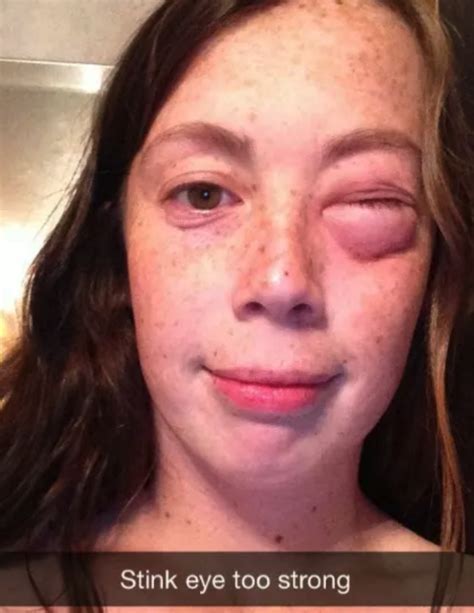27 Allergic Reactions That Are So Bad Theyll Actually Make Your Face Hurt