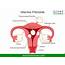 Homeopathy Treatment For Uterine Fibroids – Live Homeo