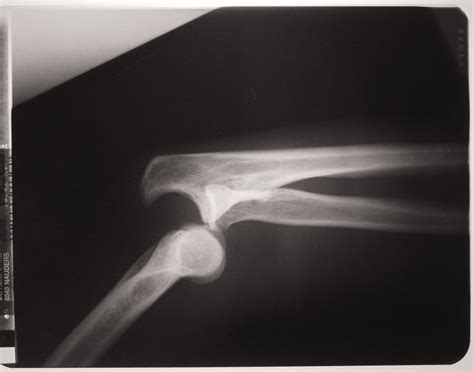 X Ray Dislocated Arm Joints St3 Interview