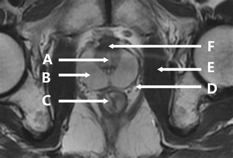 Axial T Weighted Magnetic Resonance Imaging Of The Male Pelvis The BMJ