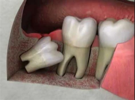 Is Wisdom Teeth Removal Necessary French Dental Services Drmiski