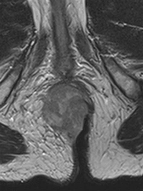Imaging Of Anal Carcinoma Ajr