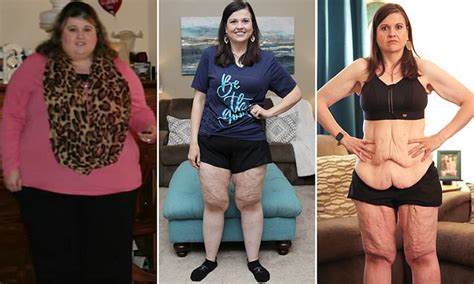 AMAZING STORIES AROUND THE WORLD Woman Who Refused To Have Gastric