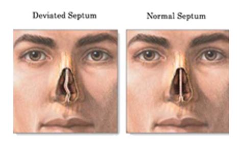 Deviated Septum Crooked Nose