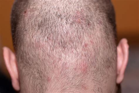 Scalp Acne Causes Treatments Myths And Prevention