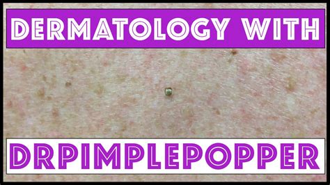 A Day In Dermatology With Dr Pimple Popper Youtube