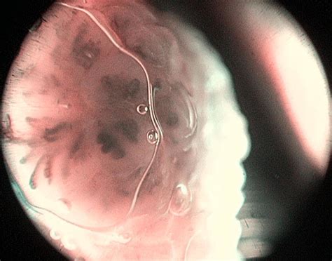 Contact Endoscopy With Nbi Perpendicular Vascular Patterns With
