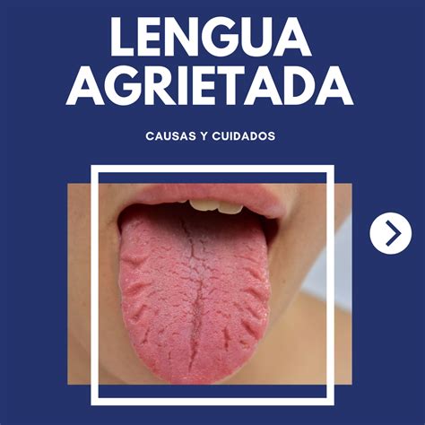 🥵 Lengua Agrietada 🥵⁣⁣ ⁣⁣ La Lengua Dental Germanies