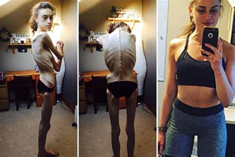 Anorexic Girl Who Refused To Sit Down During The Day ‘to Burn More Calories’ Battles Her Way