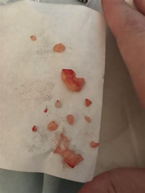 Cyst On My Leg Exploded The Other Day Got All This Out Of It It Ended