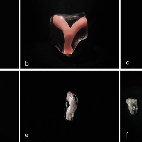 3D TVS Images Under Render Mode Of Normal Uterus A Incomplete Septum