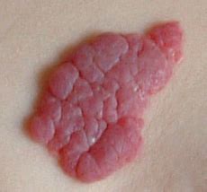 Hemangioma and other types of angiomas cherry angioma vs. Birthmarks: MedlinePlus
