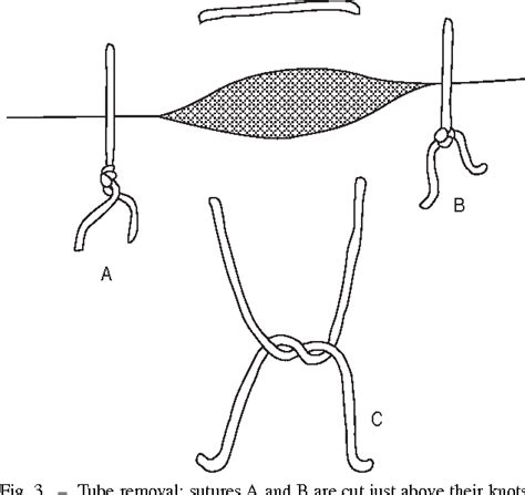 Figure 1 From A Simple Technique For Anchoring Chest Tubes Semantic