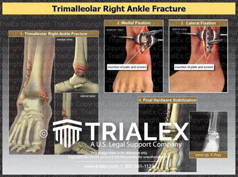Trimalleolar Right Ankle Fracture Trial Exhibits Inc