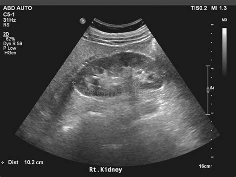 Ltrasound Images Of Kidney In Upper Abdomen For Doctor Diagnostic Stock