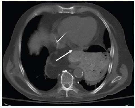 Paroxysmal Nocturnal Dyspnea And Worsening Pedal Edema Thoracic Key