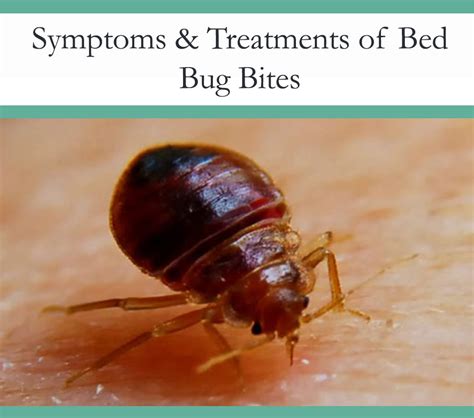 Bed Bug Bites Symptoms And Treatments The Pest Advice