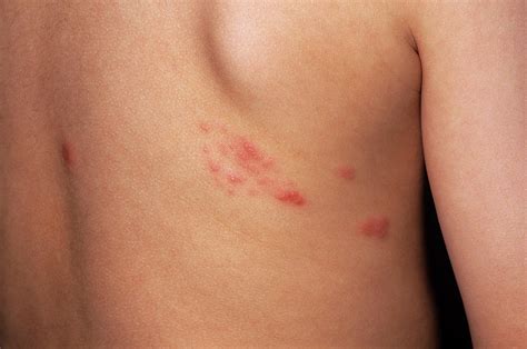 Shingles Rash Photograph By Dr P Marazziscience Photo Library