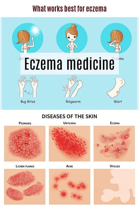 Eczema Medicine Eczema Is Typical But There Are Lots Of Ways To Deal