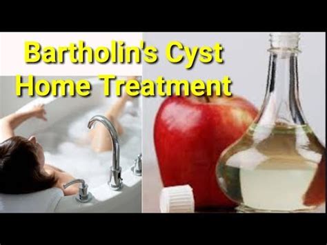 Bartholin s Cyst Home treatment 4 Effective Remedies बरथलन ससट क