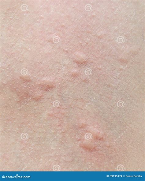 Peau Humaine Présentant Une Réaction Allergique Photo Stock Image