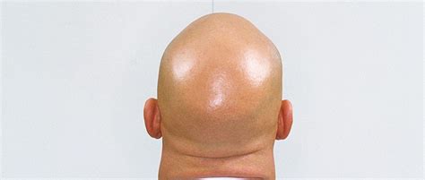 Why Are Bald Heads So Shiny When The Skin Elsewhere On Your Body Isn T Bbc Science Focus