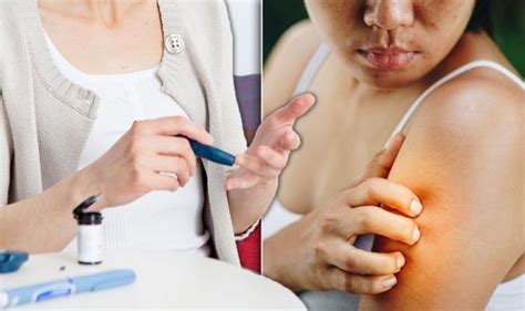 Diabetes Type 2 Symptoms High Blood Sugar Signs Include Itchy Rash