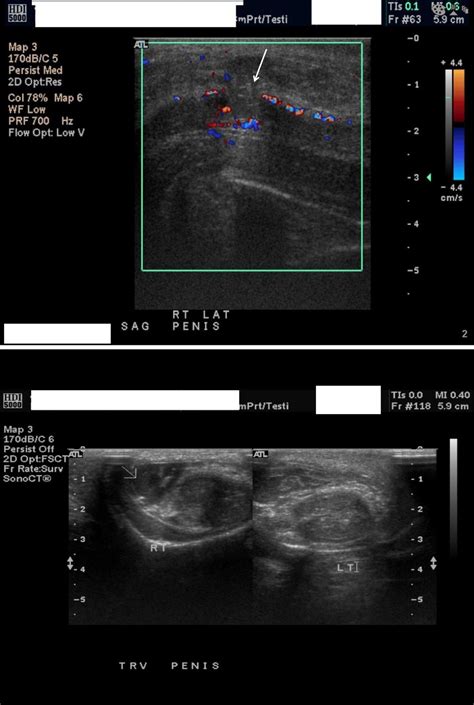 Fracture Of The Penis An Atypical Presentation International Journal