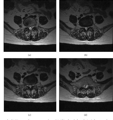 Figure 2 From Synovial Cyst Mimicking An Intraspinal Sacral Mass