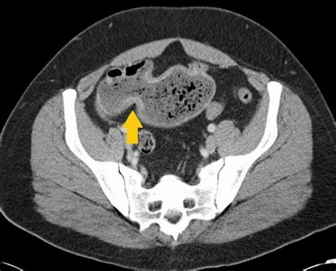 Cureus Meckels Diverticulum In Crohns Disease Revisited A Case Of