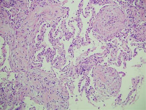 The Histological Fi Ndings Of Transbronchial Lung Biopsy Showed
