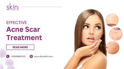Effective Acne Scar Treatment Options Skin Plus Clinic