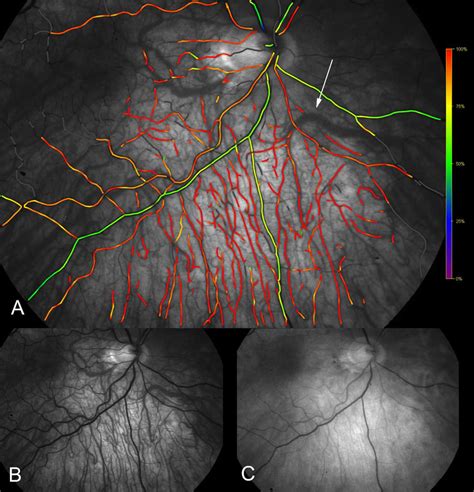 Choroidal Oximetry Image A The Vascular Bed Of The Choroid Is