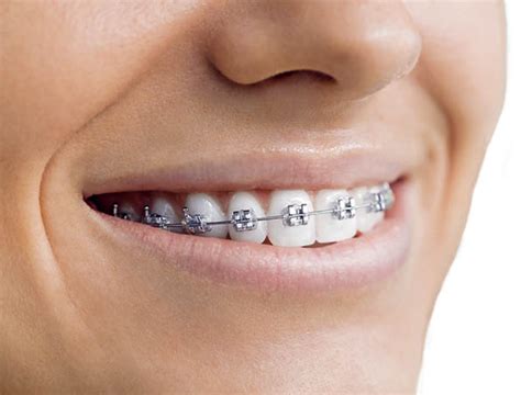 Invisalign Vs Braces The Pros And Cons Of Each Approach