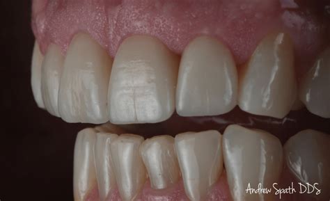 Four Front Teeth Case Study General And Cosmetic Dentist In Newport