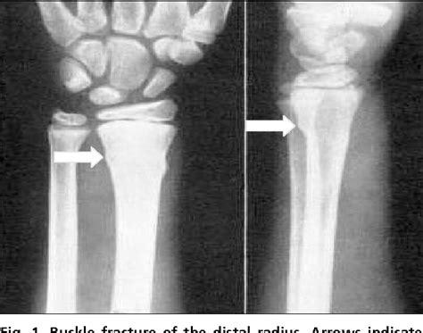 Figure 1 From Pediatric Wrist Buckle Fractures Should We Just Splint