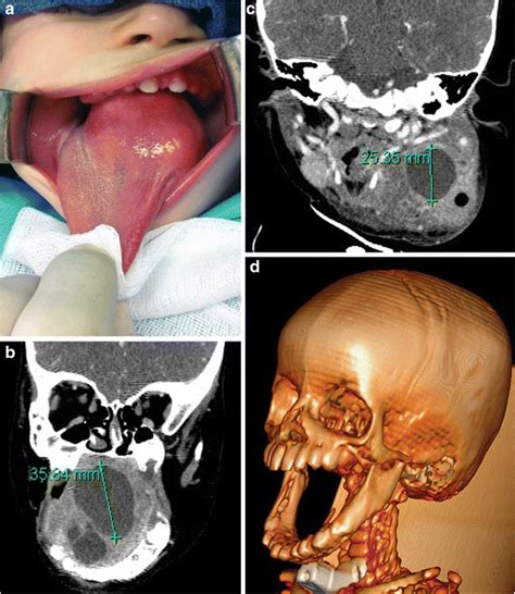A Tongue Lesion Solidified After Doxycycline Injections B C Ct Scan