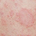 Spots appear that are lighter or darker than the surrounding skin, usually on the trunk or neck. RINGVORMIGE HUIDAFWIJKINGEN - foto's en uitleg | huidinfo ...