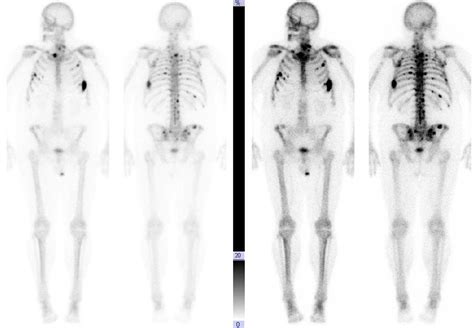Prostate Cancer Bone Metastases 6 Months After First Meta Radiology